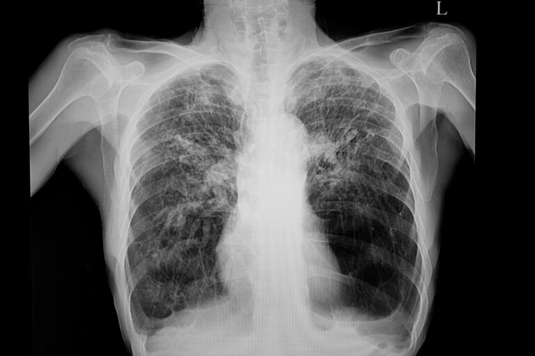 Scarring of the lungs due to occupational exposure to dust.