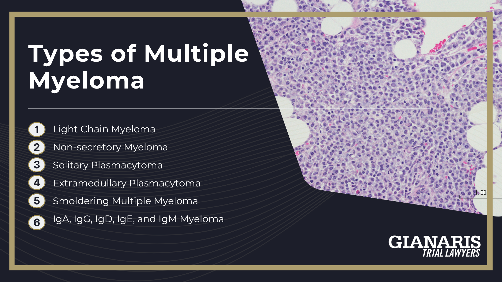 Types of Multiple Myeloma