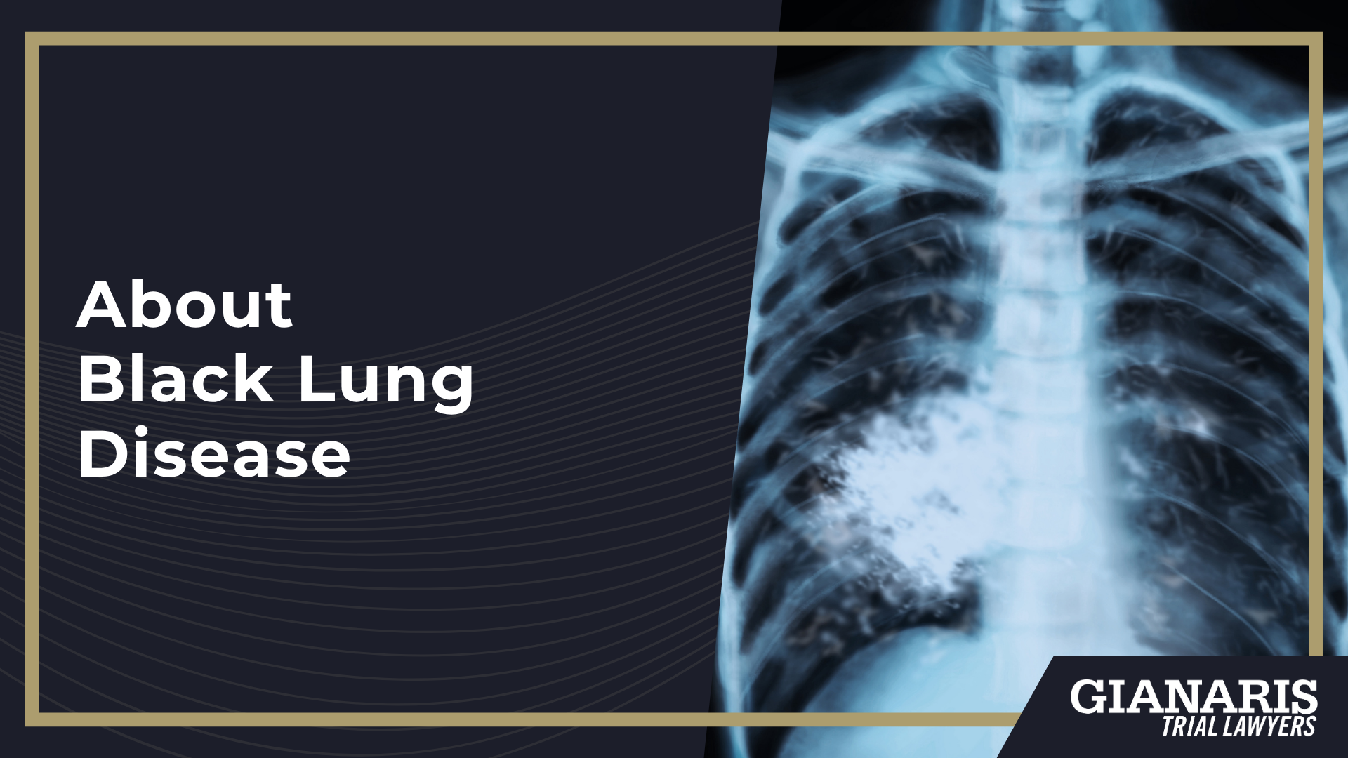 How is Black Lung (Coal Worker's Pneumoconiosis) Linked to the Railroad Industry; Railroad Jobs at an Increased Risk of Black Lung and Coal Dust Exposure; How is Black Lung (Coal Worker's Pneumoconiosis) Linked to the Railroad Industry; Railroad Jobs at an Increased Risk of Black Lung and Coal Dust Exposure