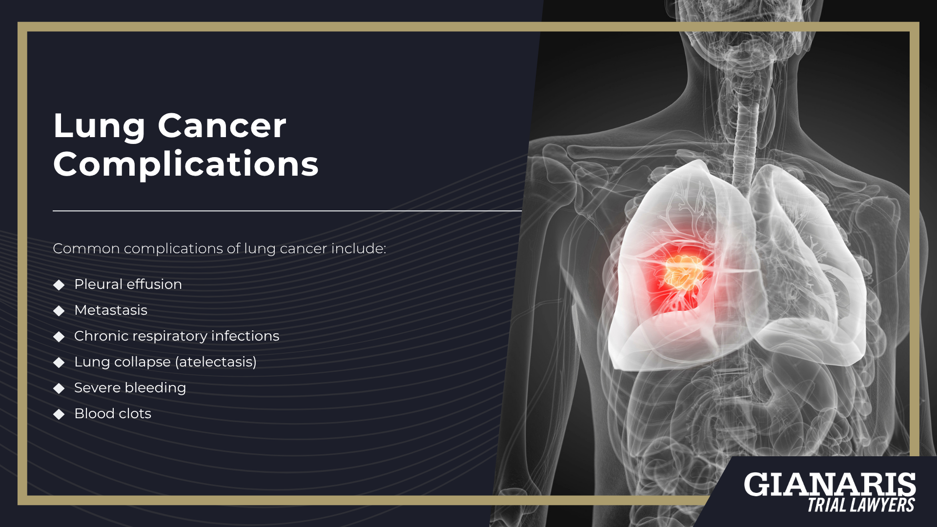 How is Lung Cancer Linked to the Railroad Industry; Railroad Jobs Linked to an Increased Risk of Lung Cancer; About Lung Cancer; Lung Cancer Complications