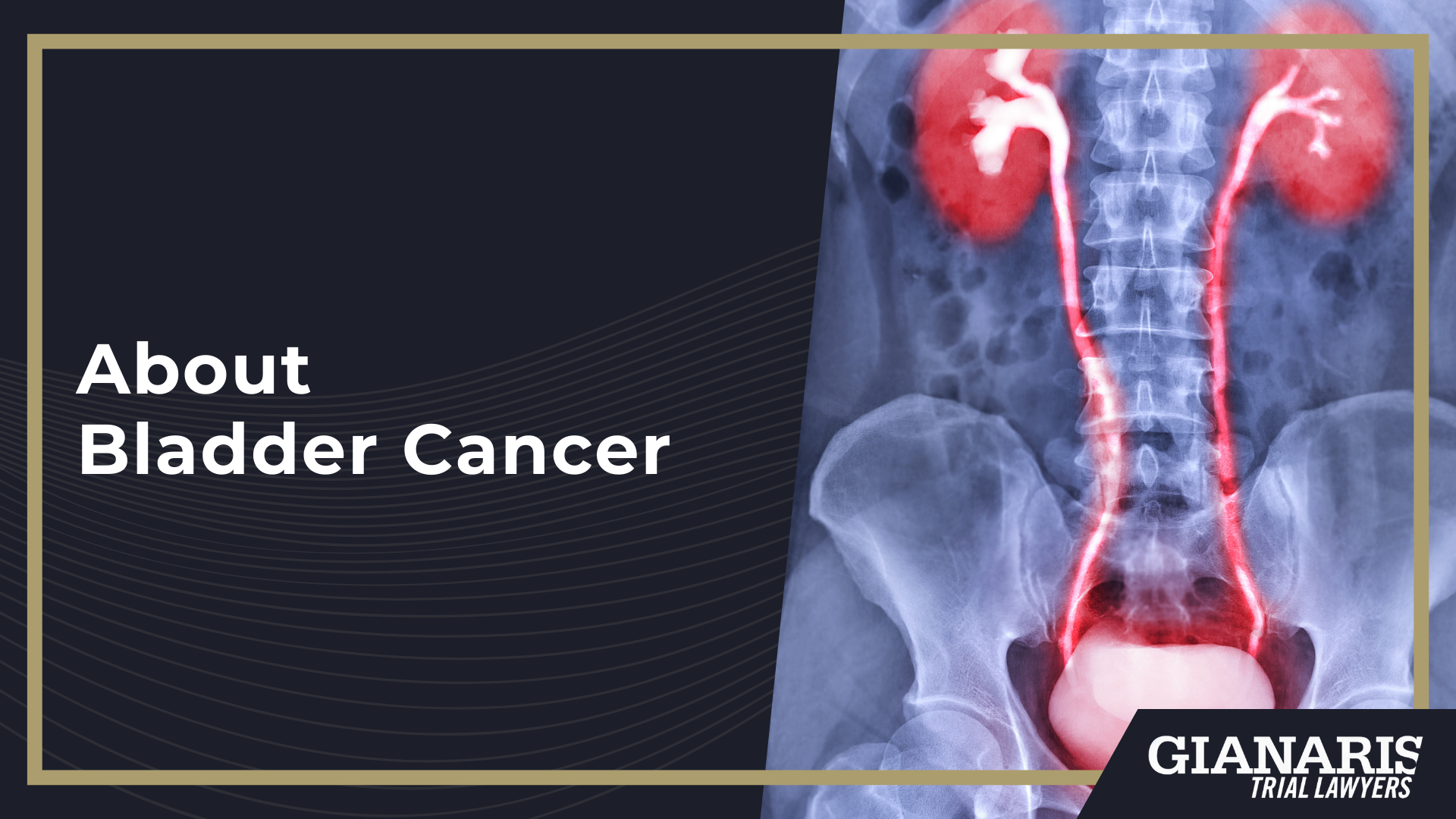 How is Bladder Cancer Linked to the Railroad Industry; Railroad Jobs Linked to an Increased Risk of Toxic Exposure and Bladder Cancer; About Bladder Cancer