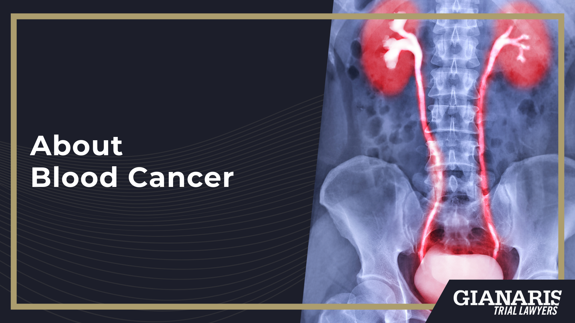 How is Blood Cancer Linked to the Railroad Industry; Railroad Jobs at Risk for Exposure to Dangerous Substances Linked to Blood Cancer; About Blood Cancer
