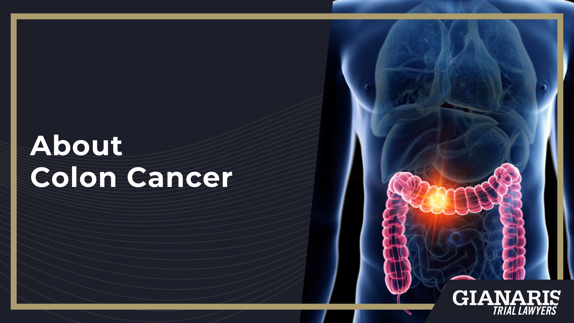 How is Colon Cancer Linked to the Railroad Industry; About Colon Cancer