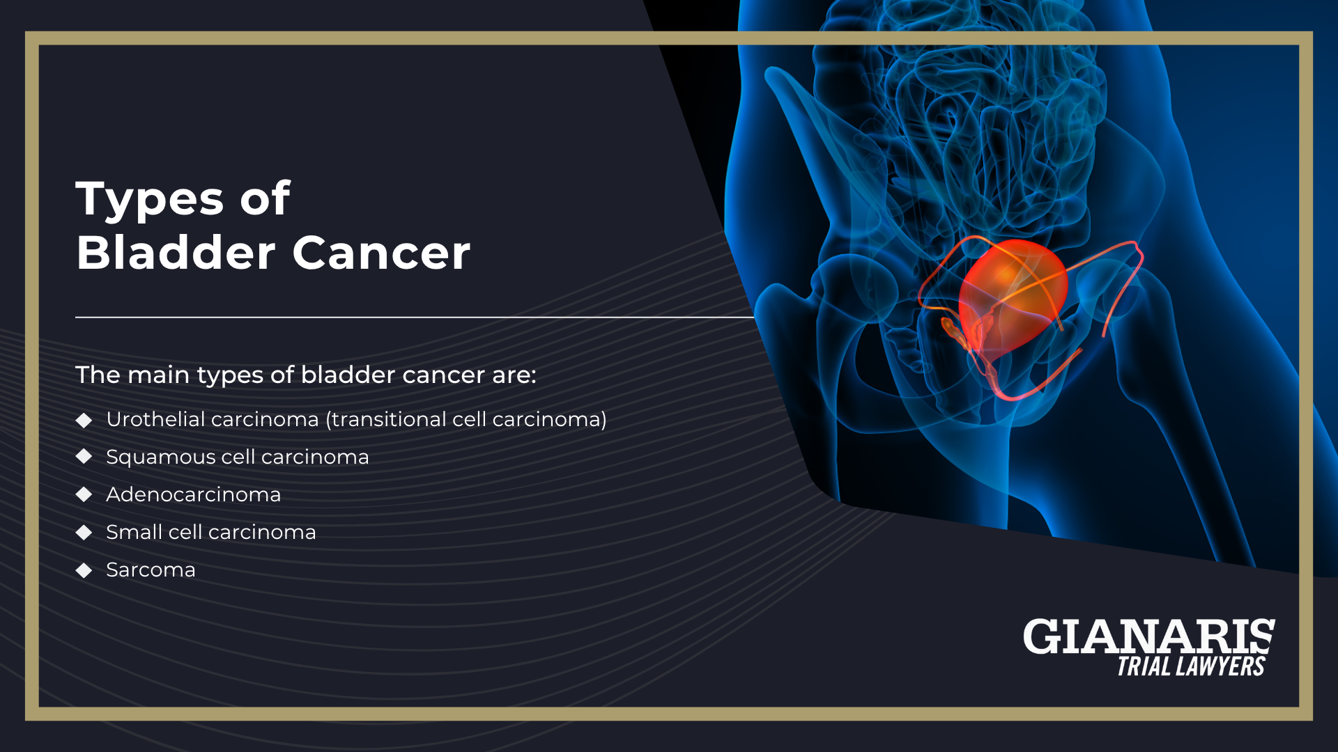 How is Bladder Cancer Linked to the Railroad Industry; Railroad Jobs Linked to an Increased Risk of Toxic Exposure and Bladder Cancer; About Bladder Cancer;  About Bladder Cancer;  Symptoms and Complications of Bladder Cancer; Types of Bladder Cancer