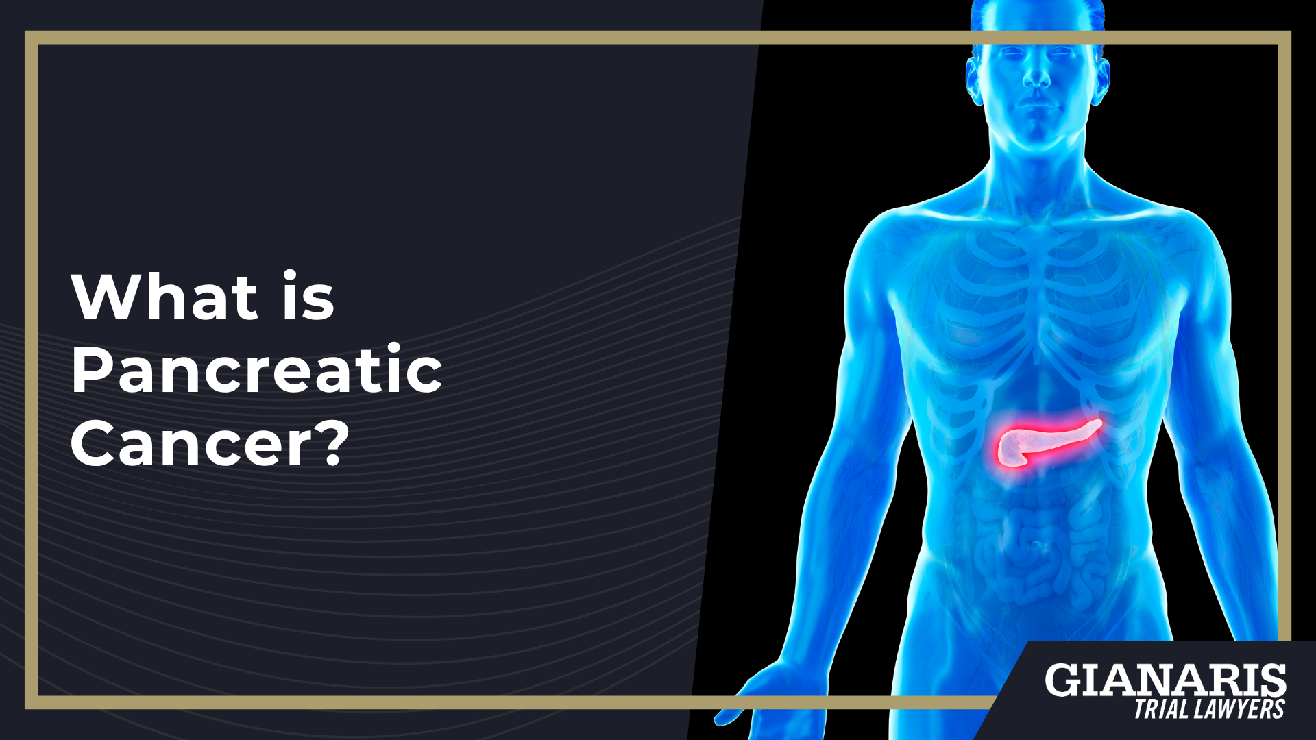 Railroad Pancreatic Cancer Lawsuit; What is Pancreatic Cancer; What is Pancreatic Cancer