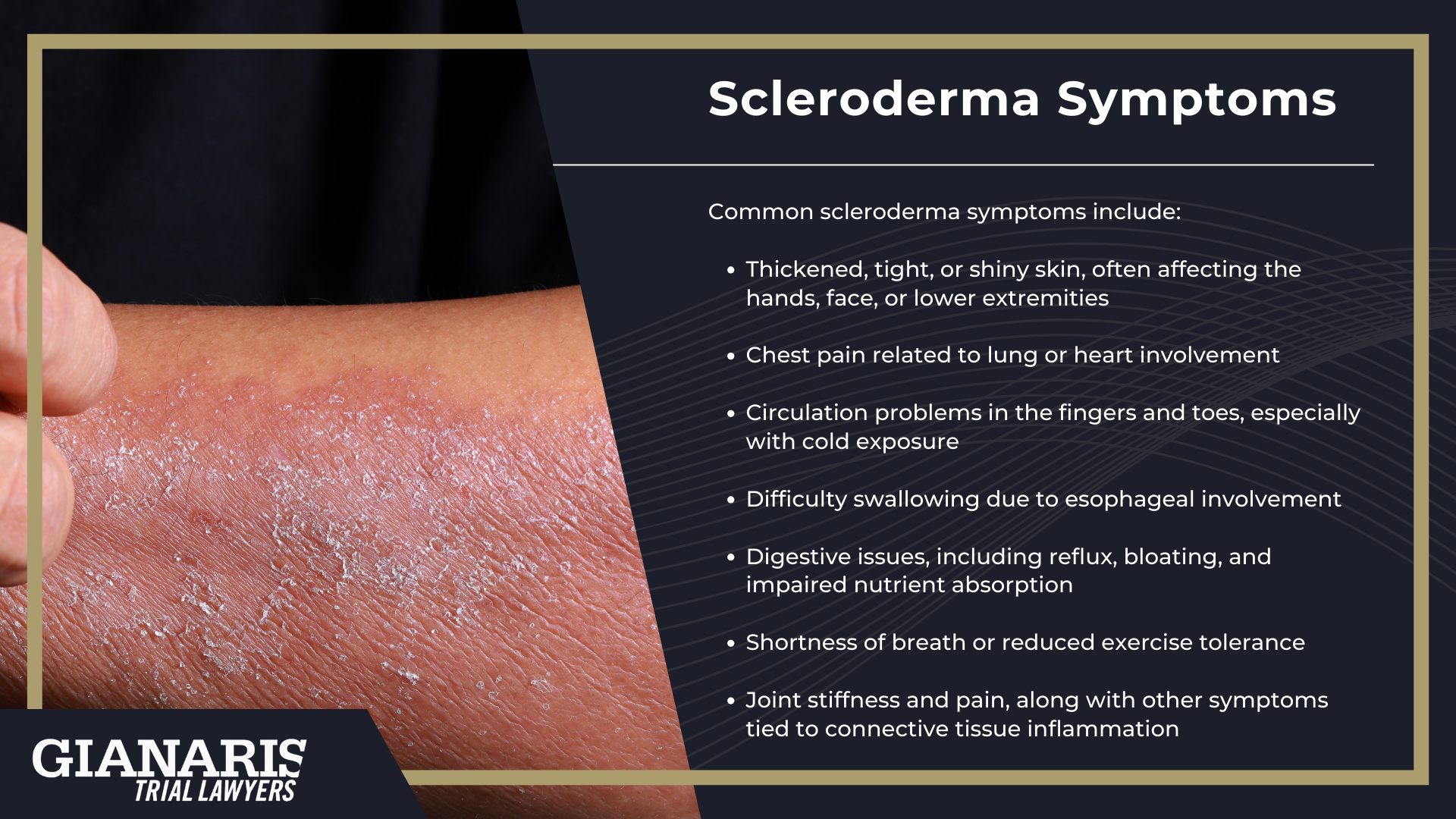 What Is Scleroderma; Scleroderma Symptoms