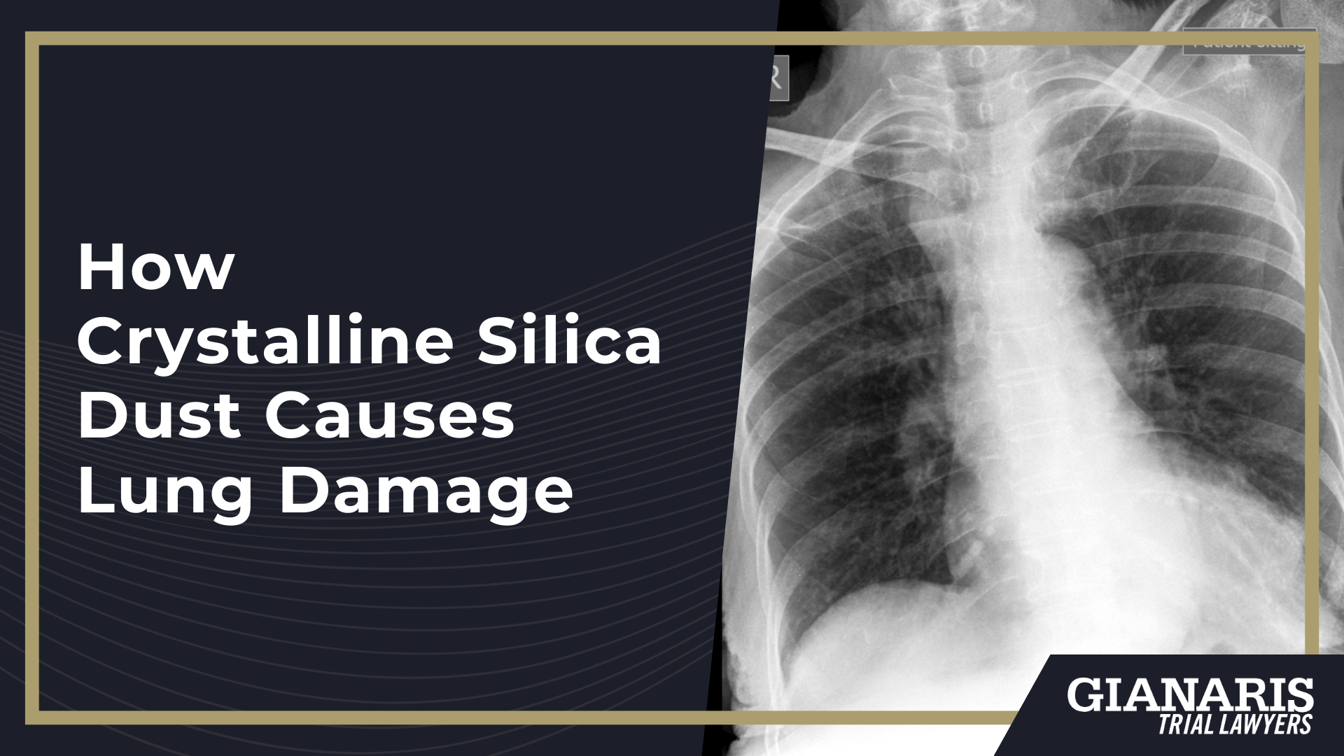 What Is Silicosis; How Crystalline Silica Dust Causes Lung Damage