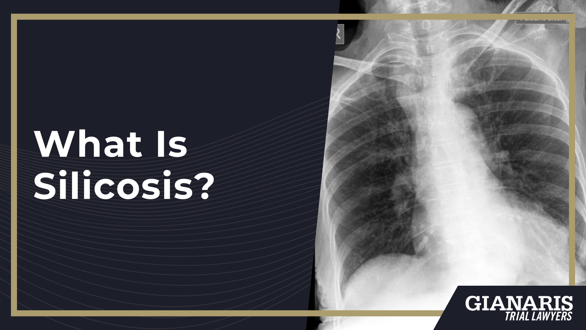 What Is Silicosis